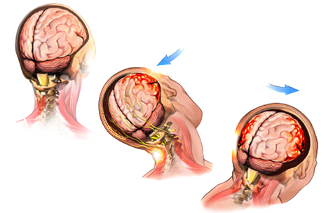 concussion-anatomy